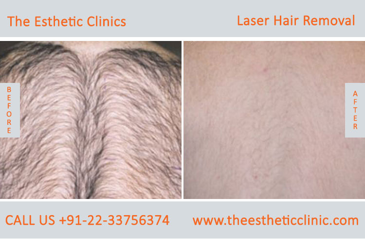Permanent Laser Hair Removal Treatment before after photos in mumbai india (3)